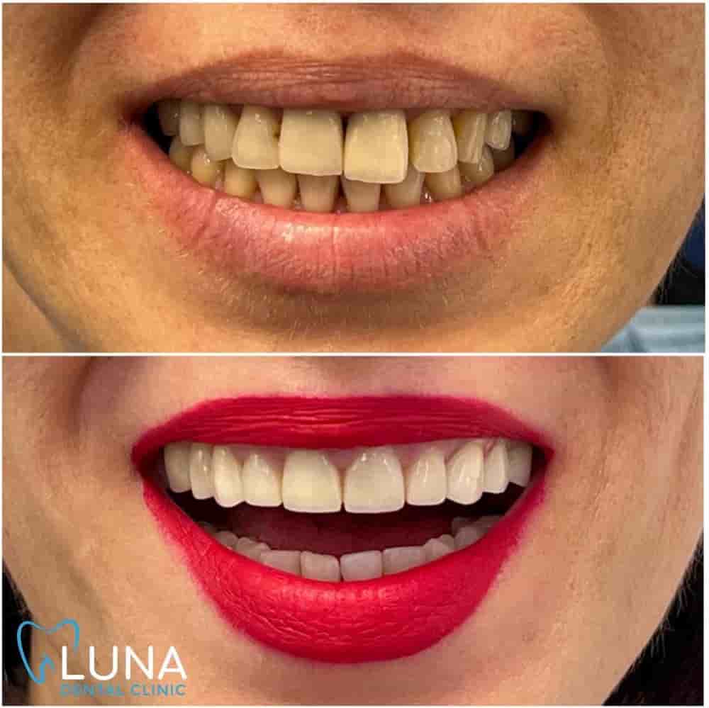 Luna Dental Clinic in Tirana, Albania Reviews from Real Patients Slider image 9