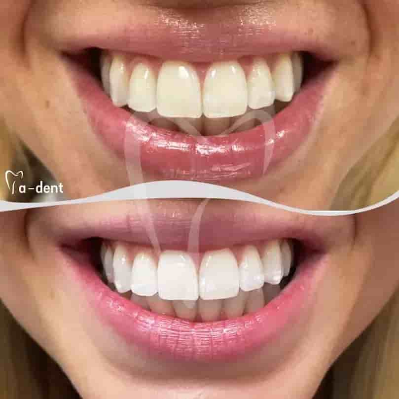 A-dent Dental Clinic in Antalya, Turkey Reviews from Real Patients Slider image 4
