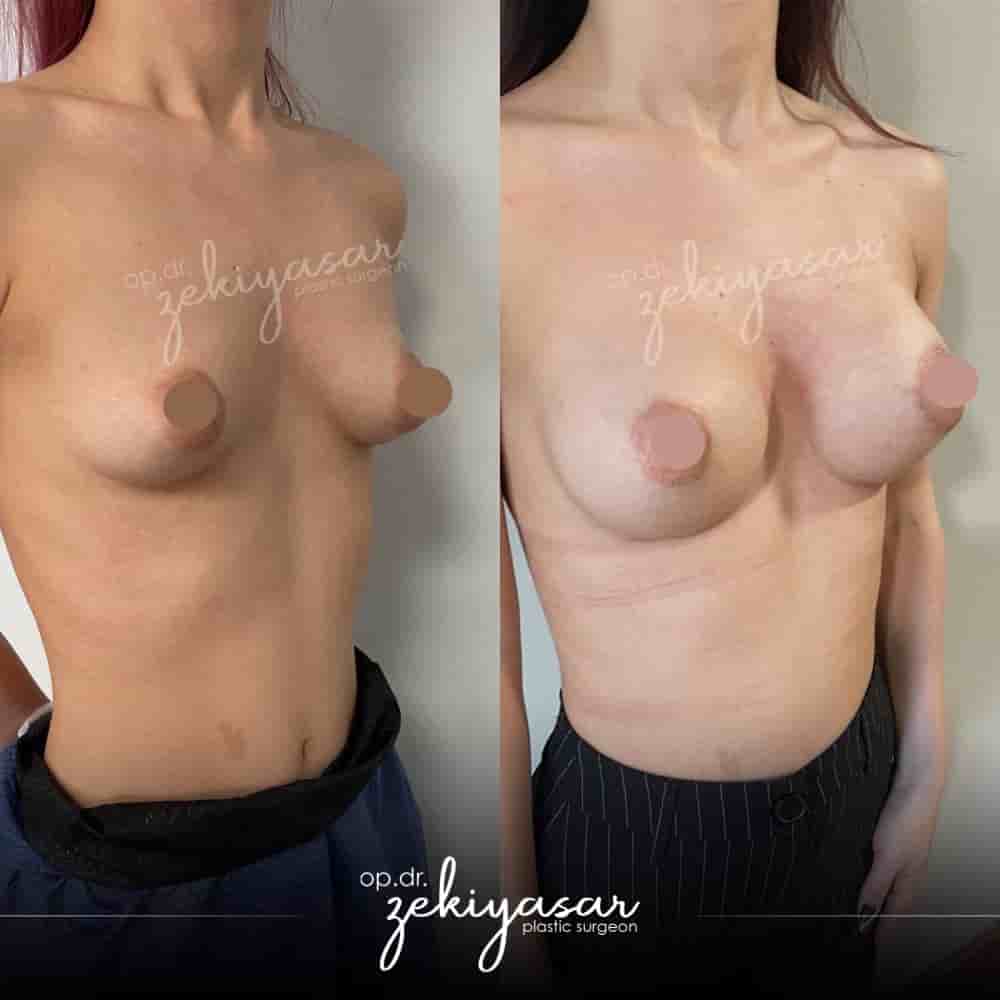 Dr. Zeki Yasar Clinic in Istanbul, Turkey Reviews from Real Patients Slider image 9