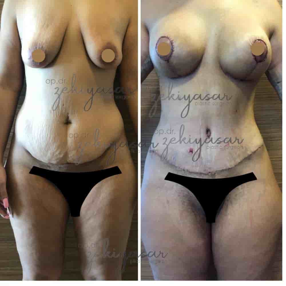 Dr. Zeki Yasar Clinic in Istanbul, Turkey Reviews from Real Patients Slider image 10