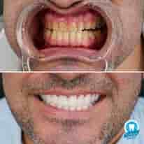 Turkiye Dental in Bursa, Turkey Reviews from Real Patients Slider image 3