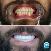 Turkiye Dental in Bursa, Turkey Reviews from Real Patients Slider image 5