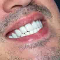 Turkiye Dental in , Turkey Reviews from Real Patients Slider image 8