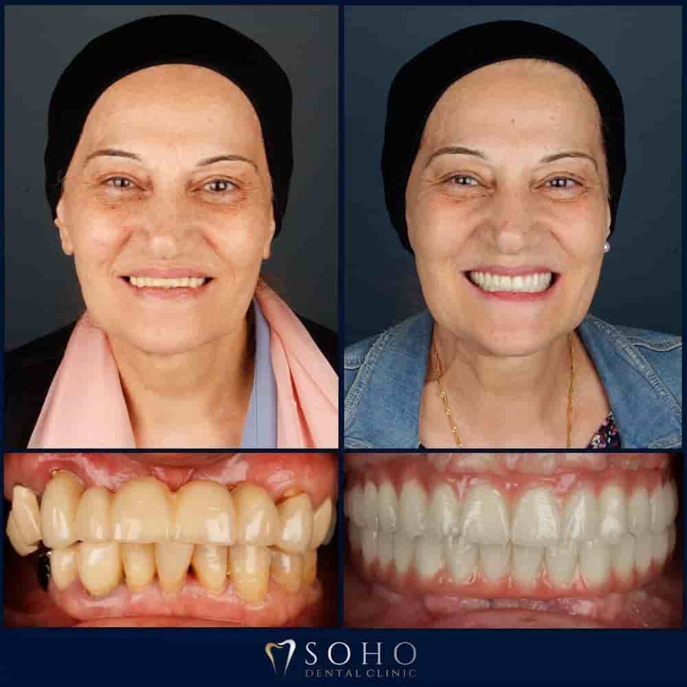Soho Dental Clinic in Istanbul, Turkey Reviews from Real Patients Slider image 8