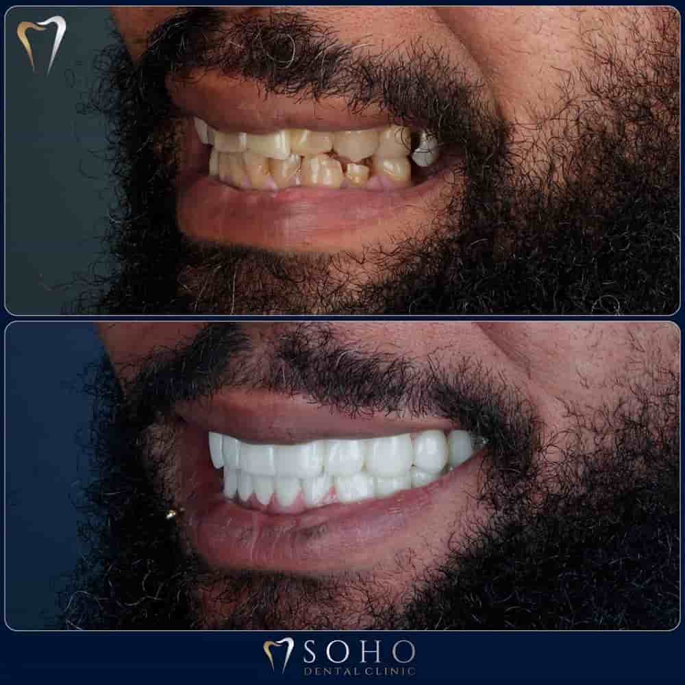 Soho Dental Clinic in Istanbul, Turkey Reviews from Real Patients Slider image 9