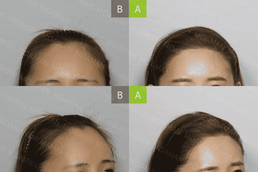 MOAMAN Hair Transplant Clinic in Seoul, South Korea Reviews from Real Patients Slider image 4