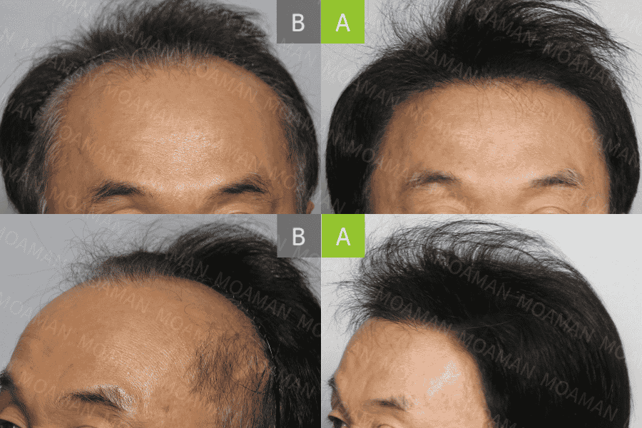 MOAMAN Hair Transplant Clinic in Seoul, South Korea Reviews from Real Patients Slider image 6