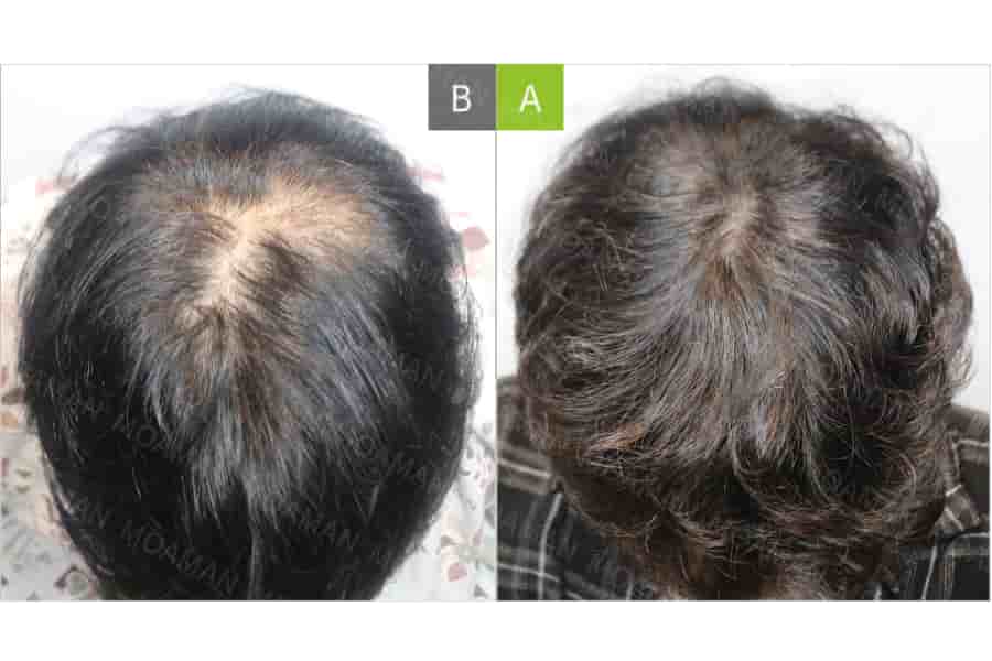 MOAMAN Hair Transplant Clinic in Seoul, South Korea Reviews from Real Patients Slider image 1