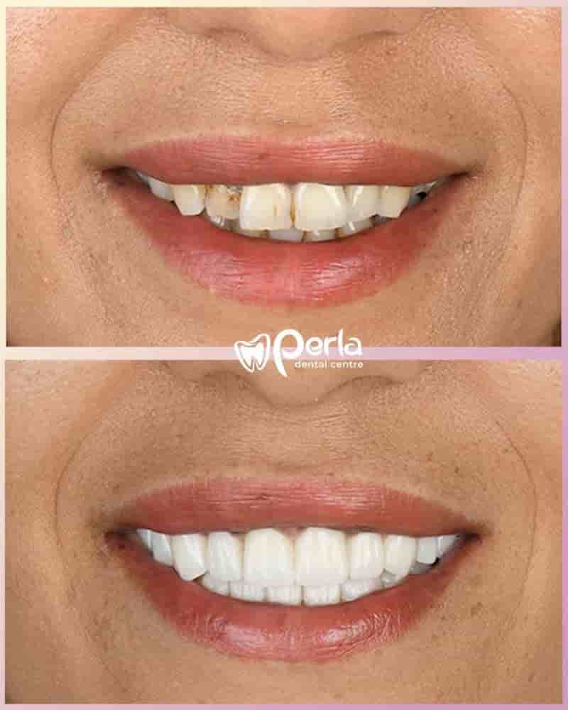 Perla Dental Centre in Antalya, Turkey Reviews from Real Patients Slider image 1