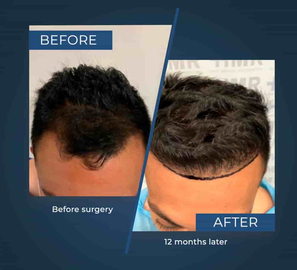 HMR - Hair Medical Restoration in Tijuana, Mexico Reviews from Real Patients Slider image 4