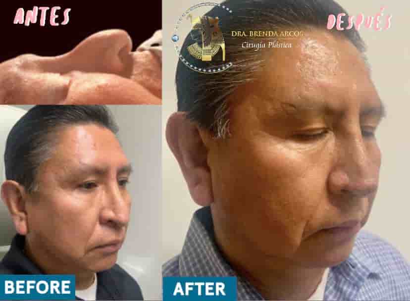 Dra. Brenda Arcos Vera Cirugia Plastica in Tijuana, Mexico Reviews from Real Patients Slider image 2