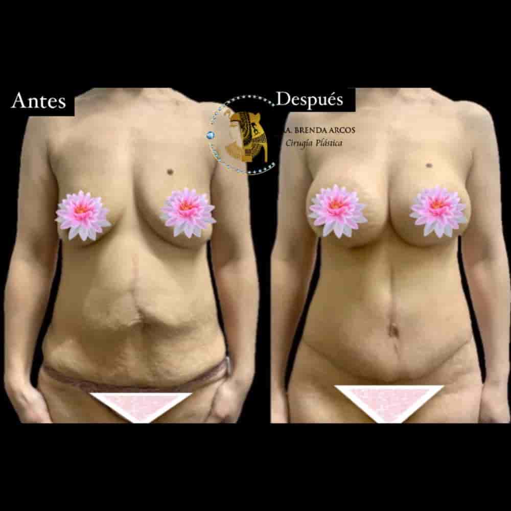 Dra. Brenda Arcos Vera Cirugia Plastica in Tijuana, Mexico Reviews from Real Patients Slider image 3