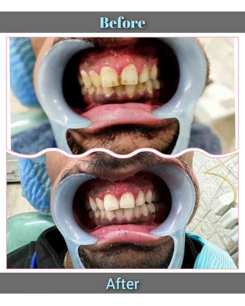 THE DENTAL PORT in Noida, India Reviews from Real Patients Slider image 7