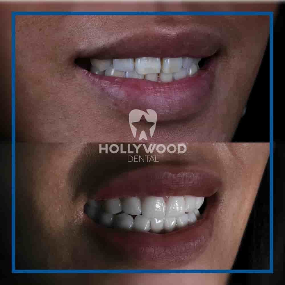 Hollywood Dental Izmir Turkey in Izmir, Turkey Reviews from Real Patients Slider image 5