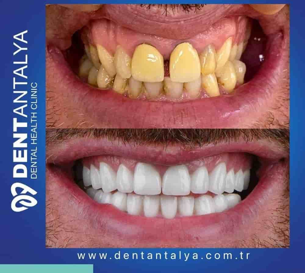 Dent Antalya in Antalya, Turkey Reviews from Real Patients Slider image 9