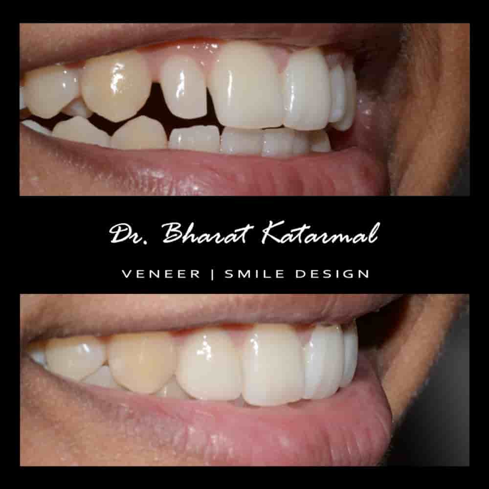 Dr. Bharat Katarmal Dental and Implant Clinic in Jamnagar, India Reviews from Real Patients Slider image 1