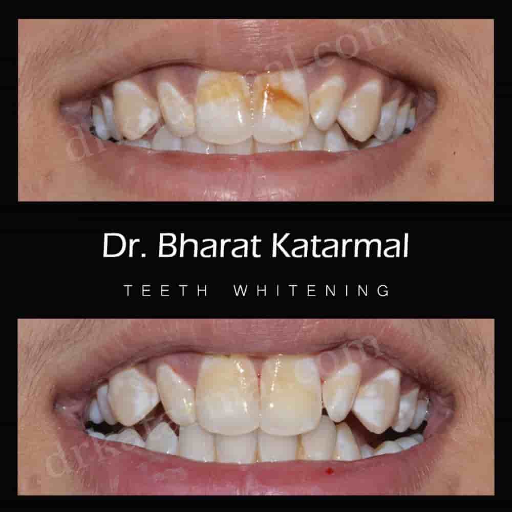 Dr. Bharat Katarmal Dental and Implant Clinic in Jamnagar, India Reviews from Real Patients Slider image 2