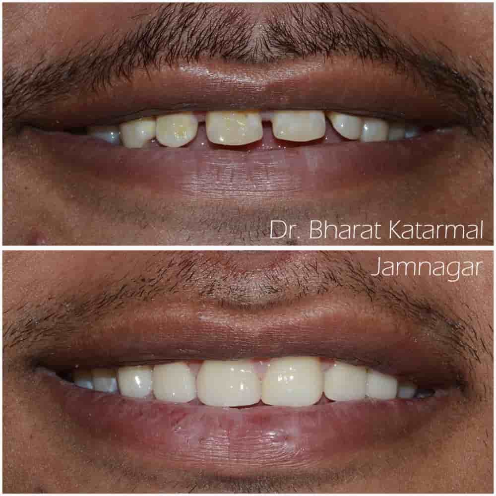 Dr. Bharat Katarmal Dental and Implant Clinic in Jamnagar, India Reviews from Real Patients Slider image 3