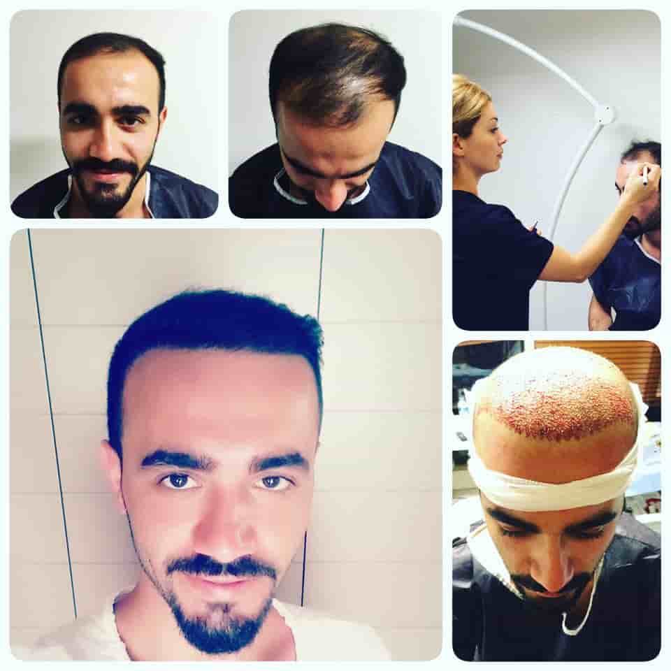Fuller Hair Transplant Clinic in Istanbul, Turkey Reviews from Real Patients Slider image 6