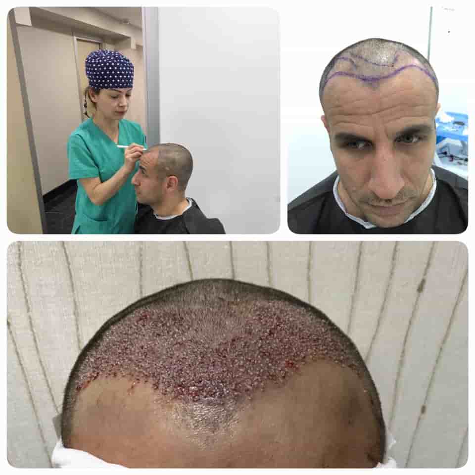 Fuller Hair Transplant Clinic in Istanbul, Turkey Reviews from Real Patients Slider image 7