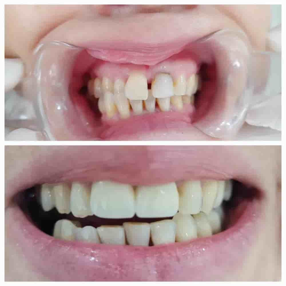 Prestij Dental Clinic in Antalya, Turkey Reviews from Real Patients Slider image 6