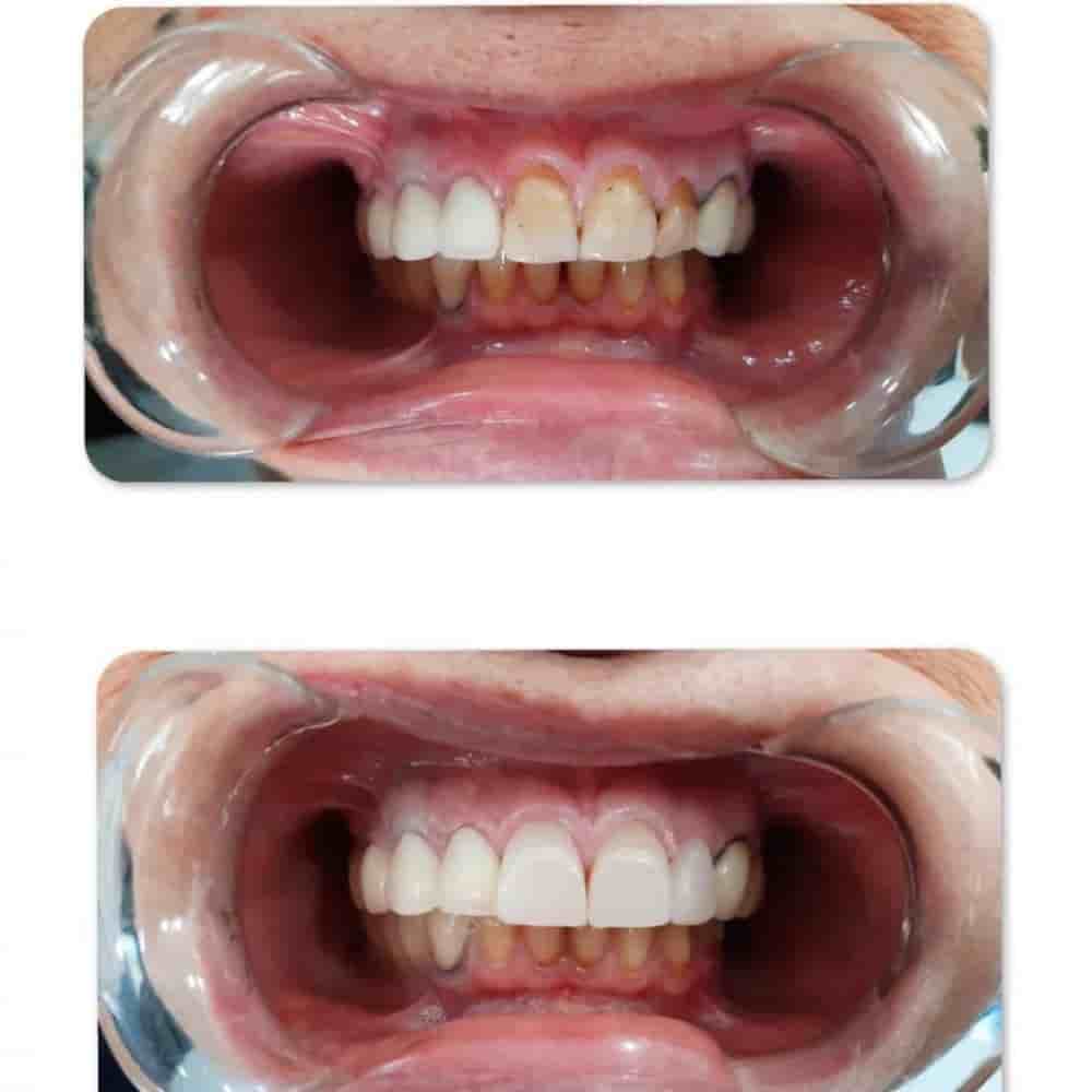 Prestij Dental Clinic in Antalya, Turkey Reviews from Real Patients Slider image 7