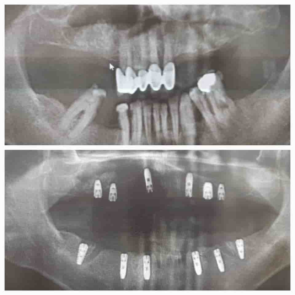 Prestij Dental Clinic in Antalya, Turkey Reviews from Real Patients Slider image 8