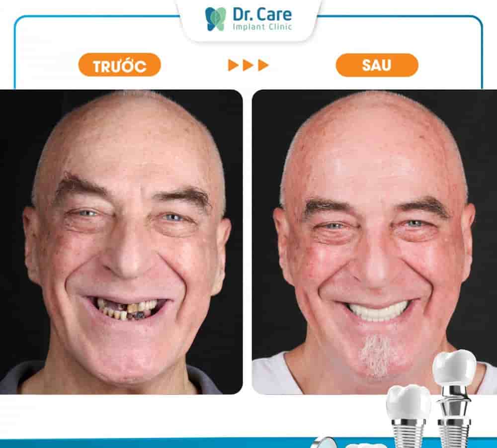 Dr. Care Implant Clinic in Ho Chi Minh, Vietnam Reviews from Real Patients Slider image 3
