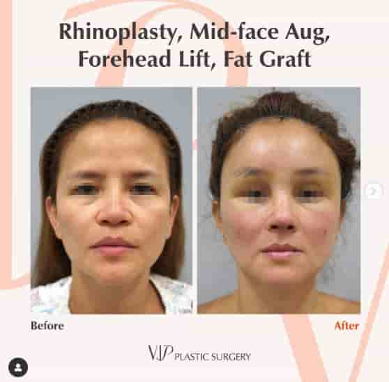 VIP Plastic Surgery in Jeju City, South Korea Reviews from Real Patients Slider image 4
