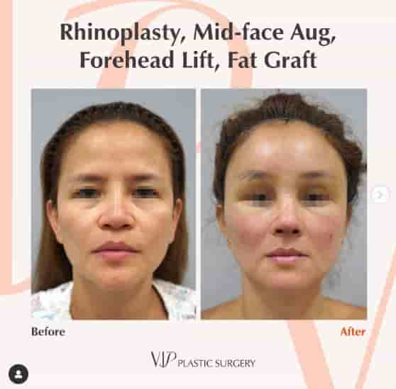 VIP Plastic Surgery in Jeju City, South Korea Reviews from Real Patients Slider image 4
