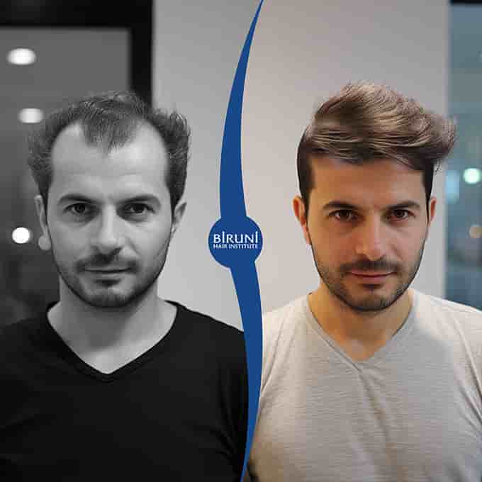 Biruni Hair Institute in Istanbul, Turkey Reviews from Real Patients Slider image 1
