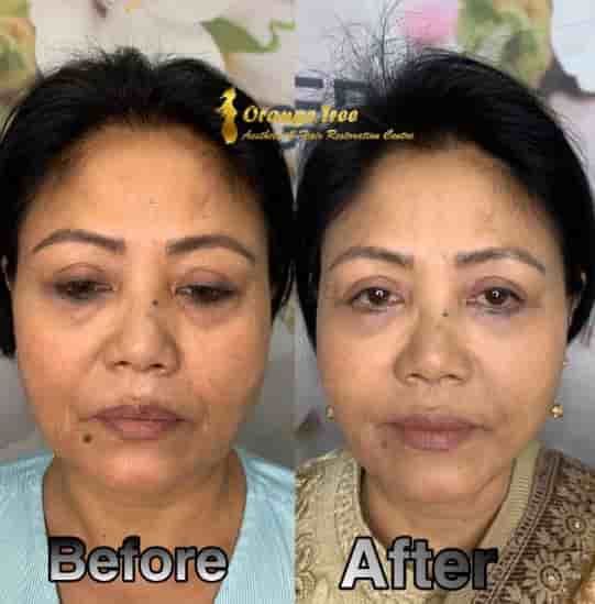 Orange Tree Aesthetic And Hair Restoration Centre in New Delhi, India Reviews from Real Patients Slider image 4