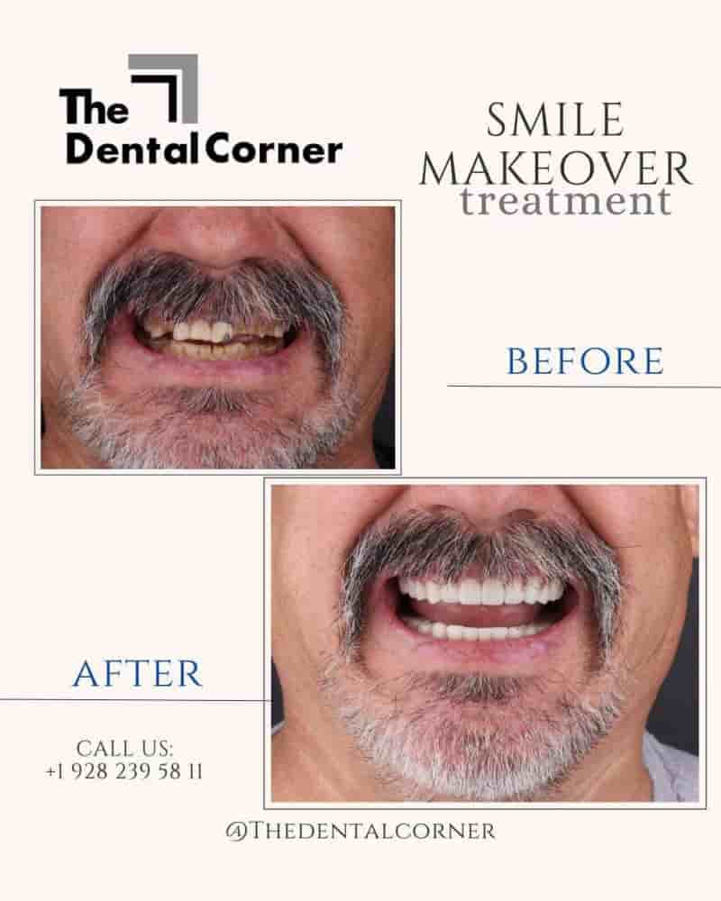 The Dental Corner in Los Algodones,Mexicali, Mexico Reviews from Real Patients Slider image 9