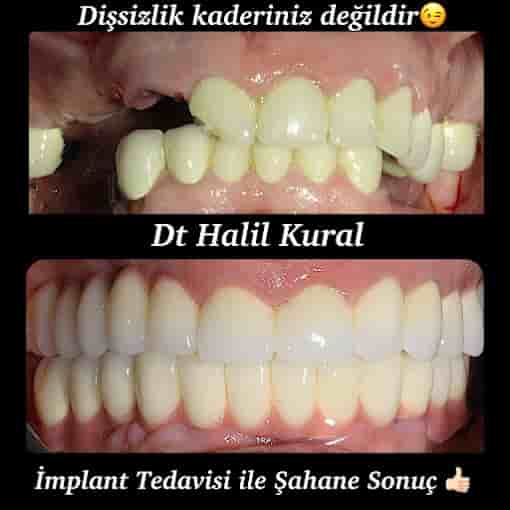 Dr. Halil Kural in Antalya, Turkey Reviews from Real Patients Slider image 6