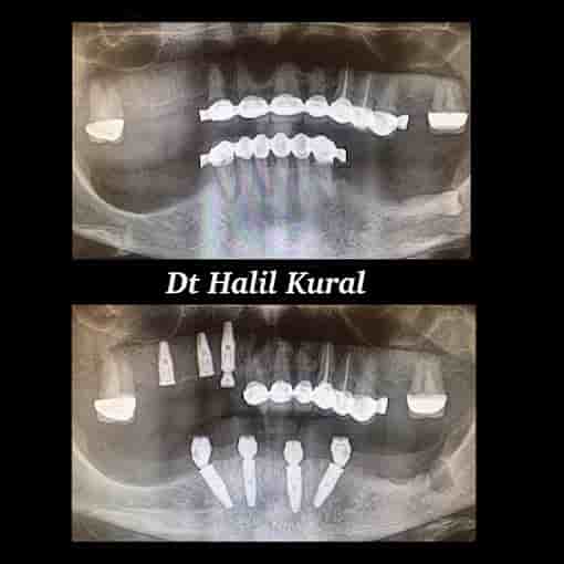 Dr. Halil Kural in Antalya, Turkey Reviews from Real Patients Slider image 8