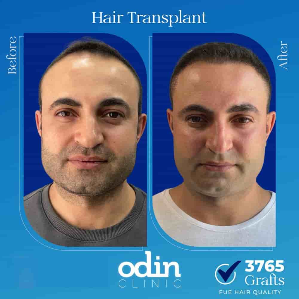 Odin Clinic in Izmir, Turkey Reviews from Real Patients Slider image 3