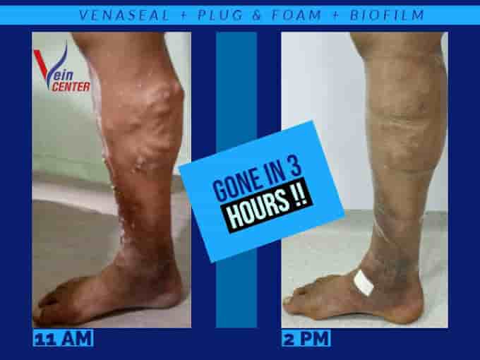 The Vein Center India in Mumbai, India Reviews from Real Patients Slider image 1