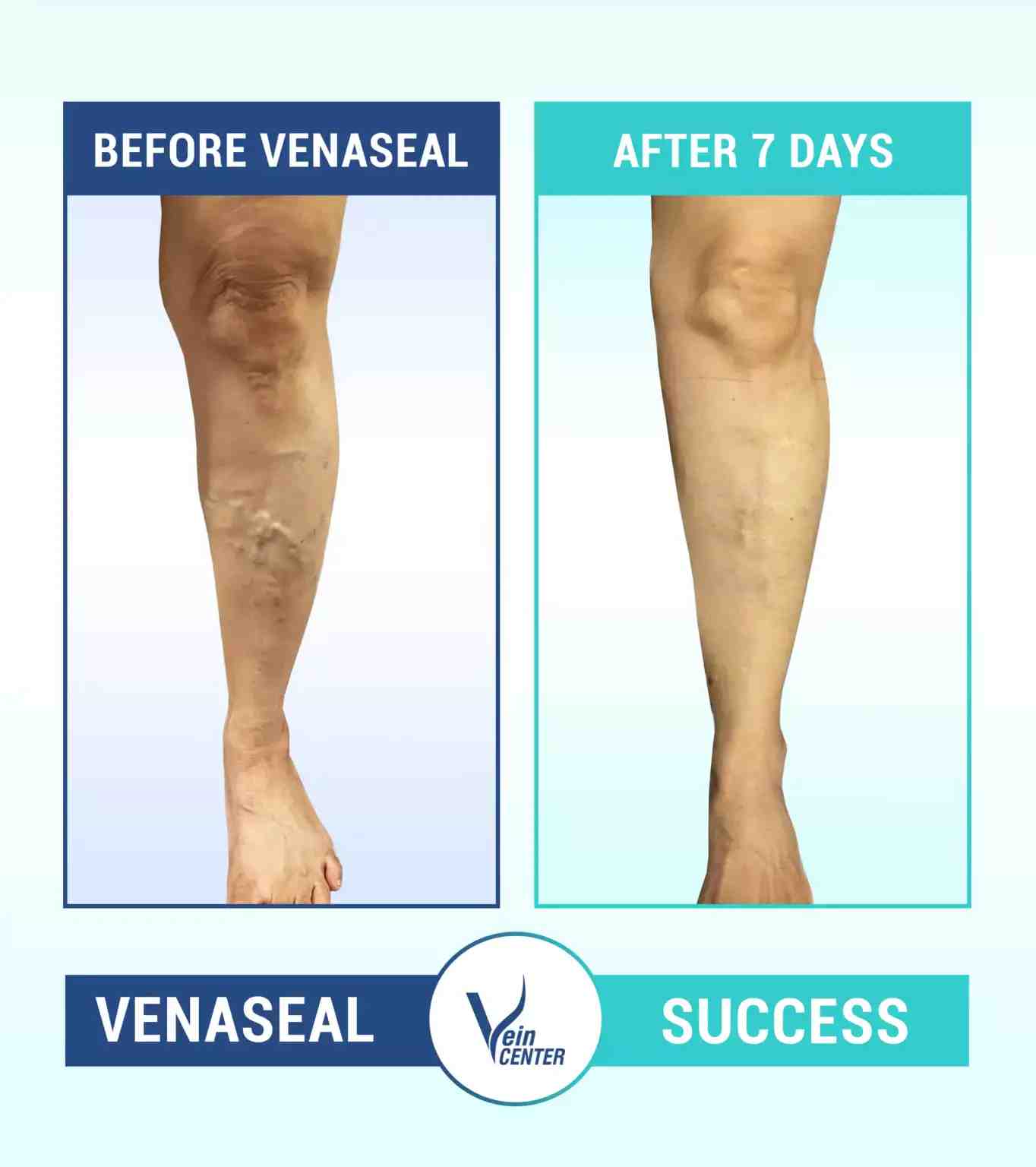 The Vein Center India in Mumbai, India Reviews from Real Patients Slider image 7