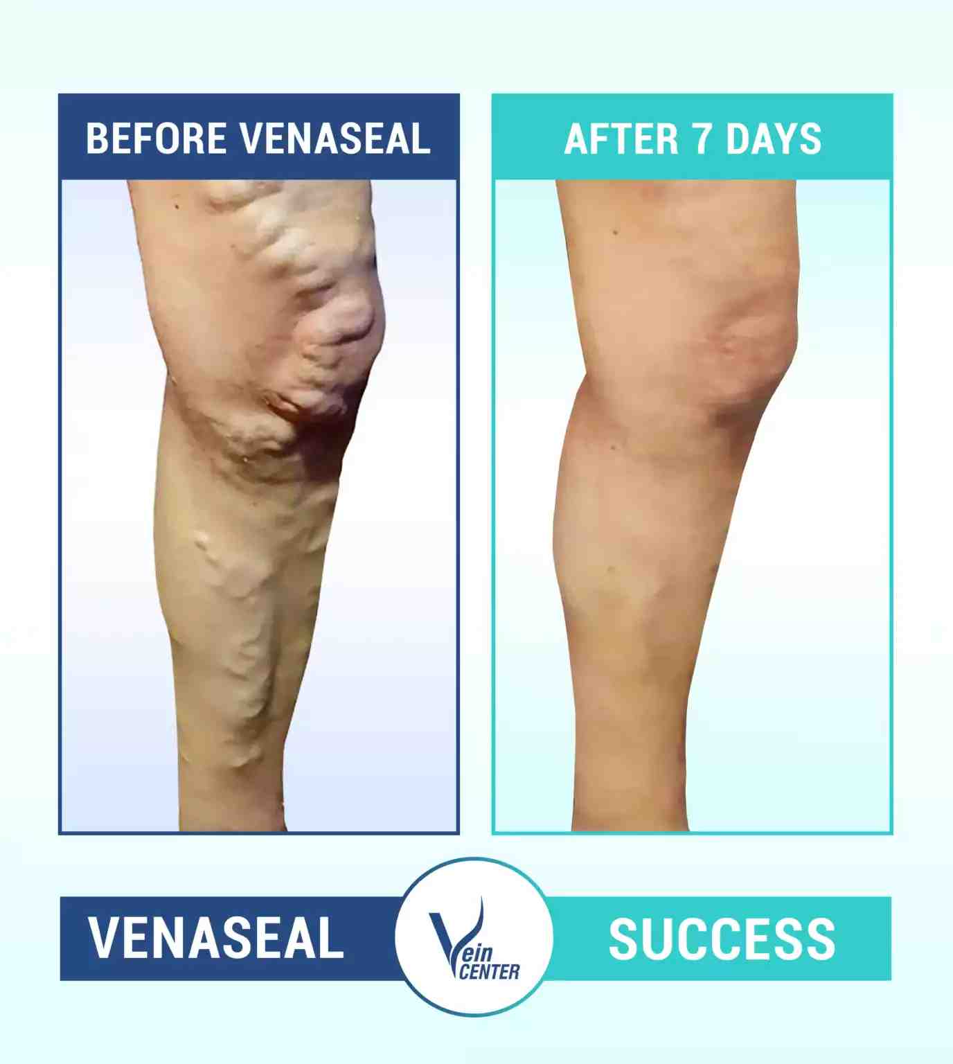 The Vein Center India in Mumbai, India Reviews from Real Patients Slider image 8