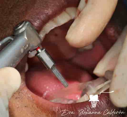 Dental Implants in Colombia Dr Johanna Calderon - Aesthetic and Specialized Dentistry in Bogota,Cali,Ibague, Colombia Reviews from Real Patients Slider image 2
