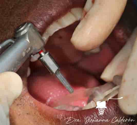 Dental Implants in Colombia Dr Johanna Calderon in Medellin,Bogota,Cali,Barranquilla,Cartagena,Ibague, Colombia Reviews from Real Patients Slider image 2