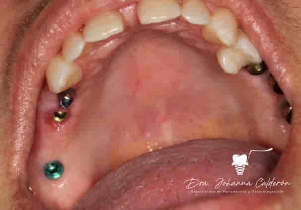Dental Implants in Colombia Dr Johanna Calderon in Medellin,Bogota,Cali,Barranquilla,Cartagena,Ibague, Colombia Reviews from Real Patients Slider image 3