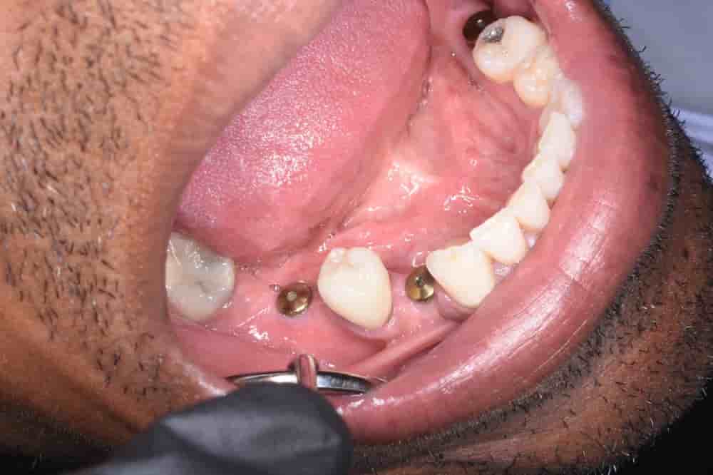 Dental Implants in Colombia Dr Johanna Calderon in Medellin,Bogota,Cali,Barranquilla,Cartagena,Ibague, Colombia Reviews from Real Patients Slider image 4