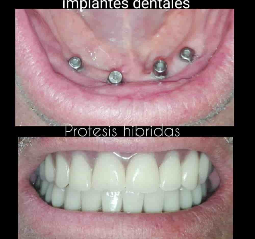 Dental Implants in Colombia Dr Johanna Calderon - Aesthetic and Specialized Dentistry in Bogota,Cali,Ibague, Colombia Reviews from Real Patients Slider image 10