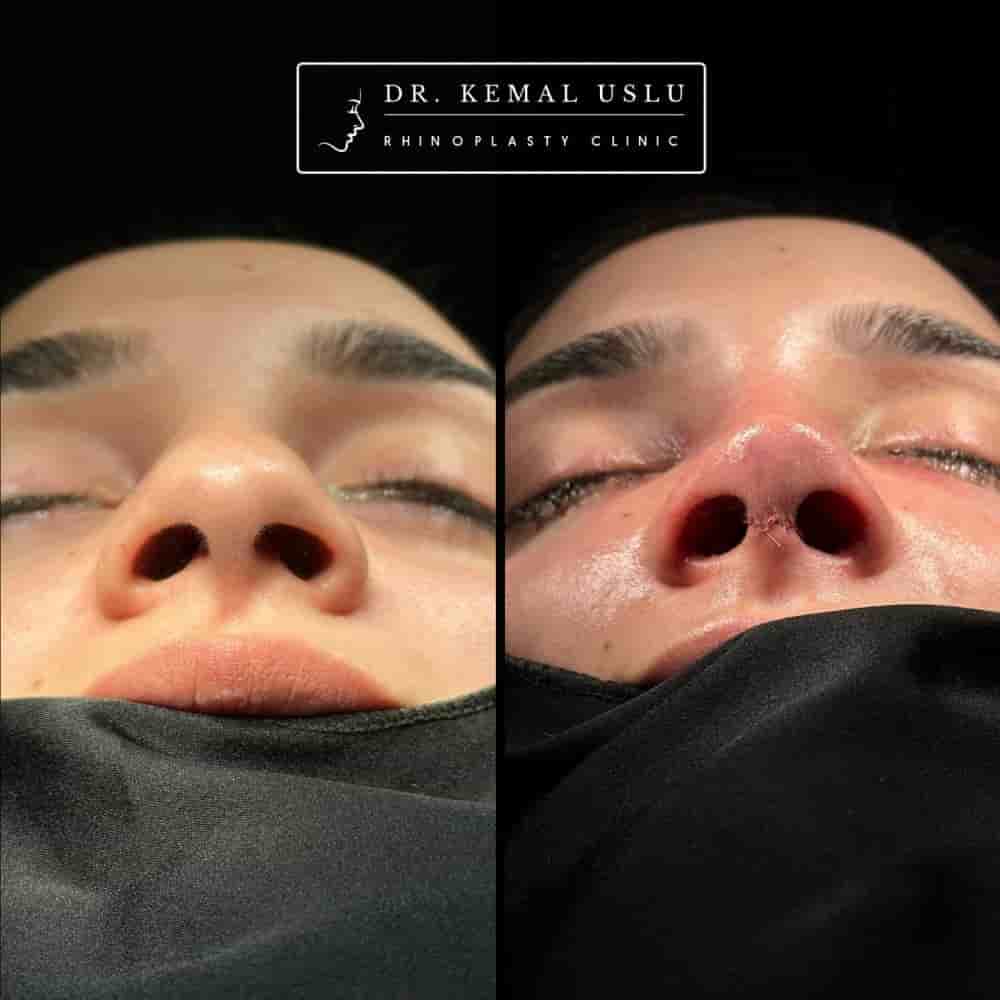 Dr. Kemal Uslu Clinic in Istanbul, Turkey Reviews from Real Patients Slider image 4