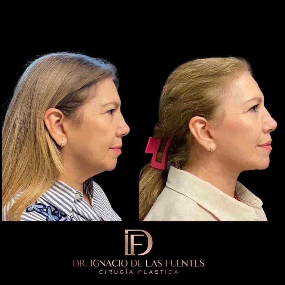 Dr. Ignacio De Las Fuentes in Tijuana, Mexico Reviews from Real Patients Slider image 1