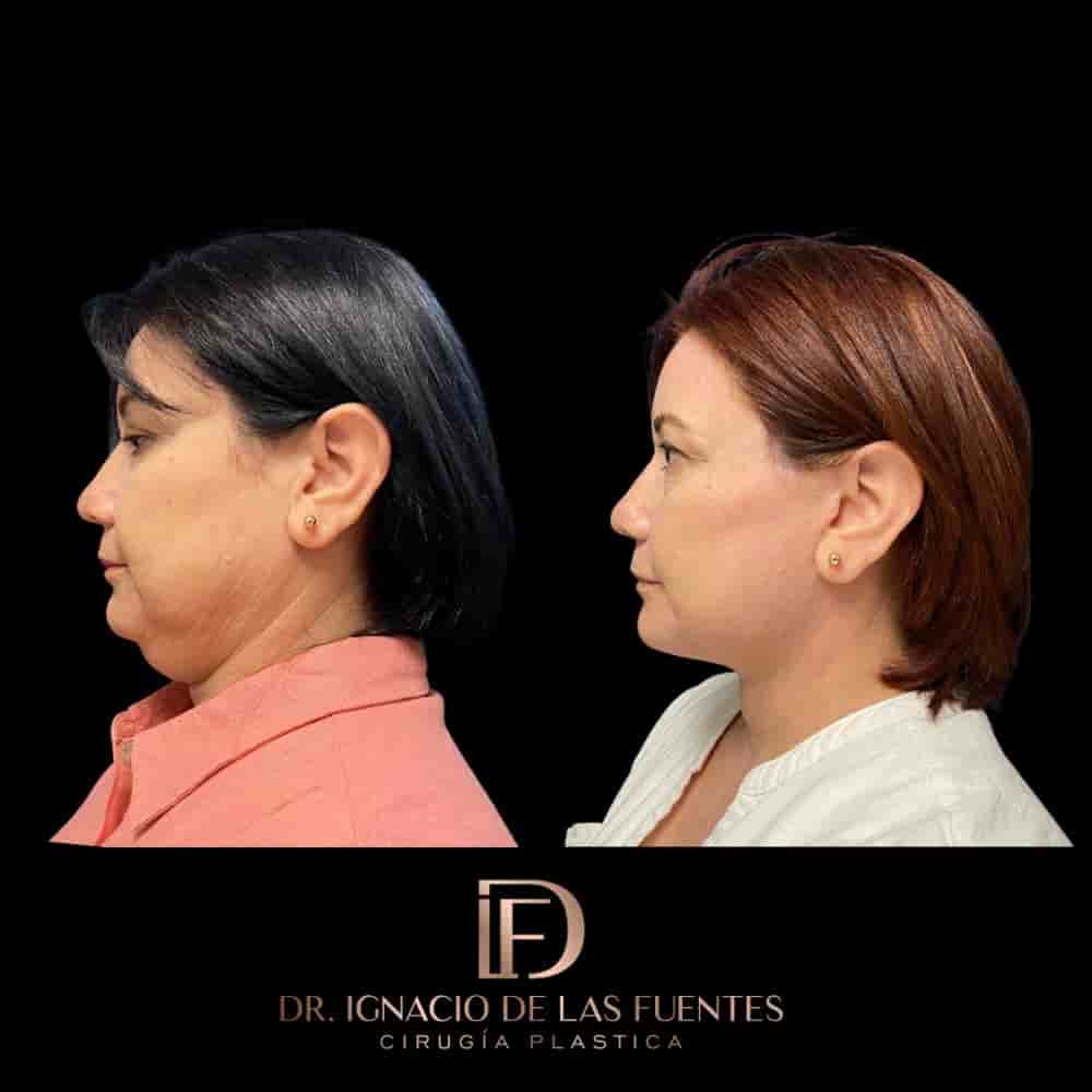 Dr. Ignacio De Las Fuentes in Tijuana, Mexico Reviews from Real Patients Slider image 4