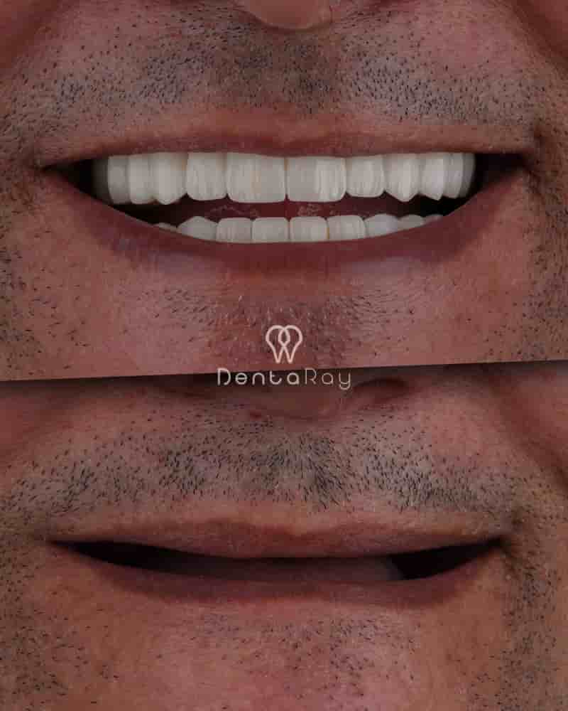 Verified Patient Reviews of Dentaray Clinic luxury Dental Clinic in Istanbul in Istanbul, Turkey Slider image 5