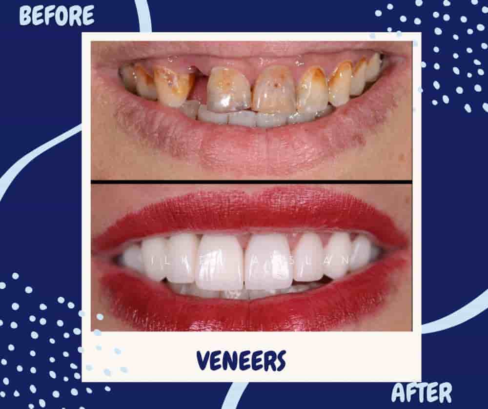 Verified Patient Reviews of Universe Dental - Best Dental Clinic in Tbilisi, Georgia in Tbilisi, Georgia Slider image 4