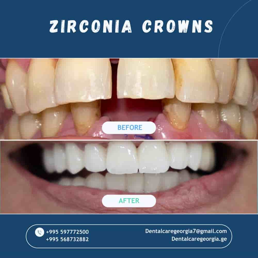 Verified Patient Reviews of Universe Dental - Best Dental Clinic in Tbilisi, Georgia in Tbilisi, Georgia Slider image 5